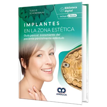 Implantes en la zona estética