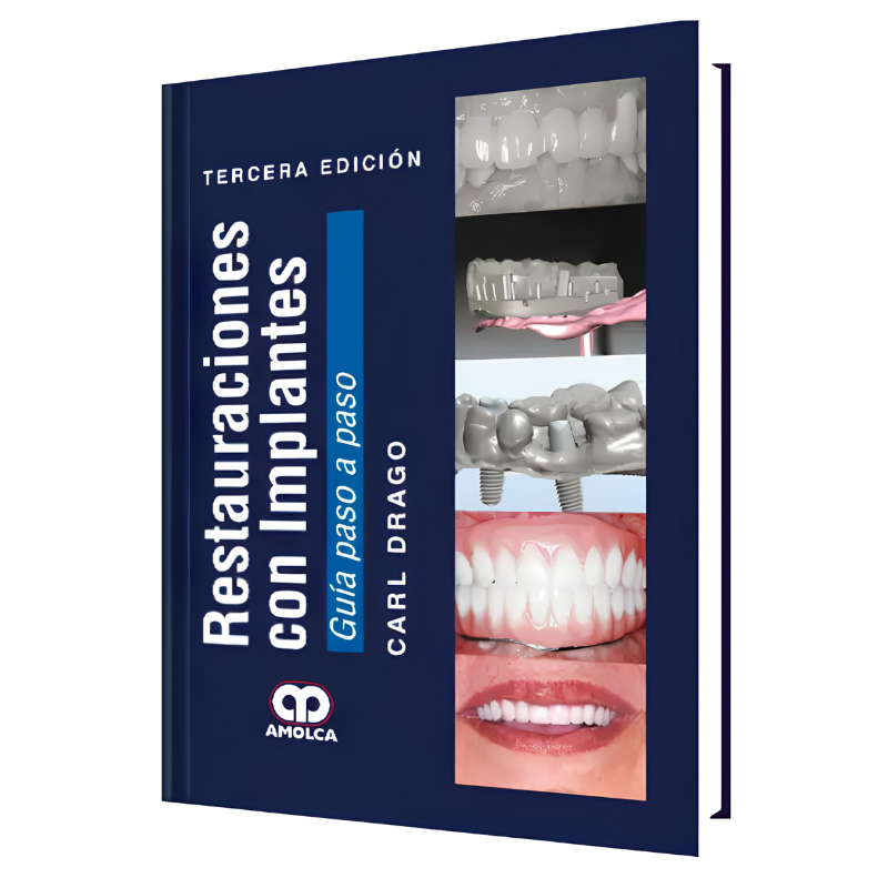 Restauraciones con Implantes. Guía Paso a Paso. 3 Edición
