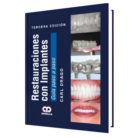 Restorations with implants. Step by step guide. 3 edition