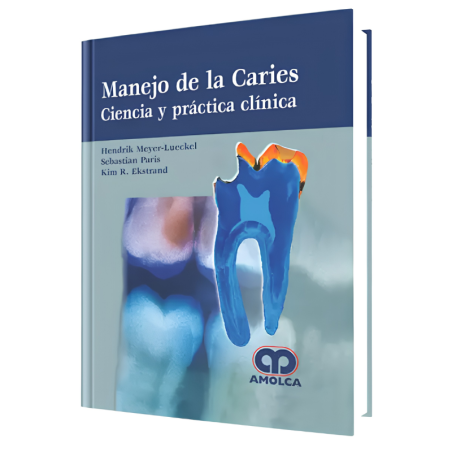 Manejo de la Caries Ciencia y práctica clínica