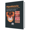 Hipodoncia