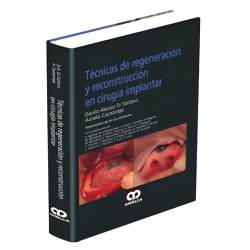 Técnicas de Regeneración y Reconstrucción en Cirugía Implantar