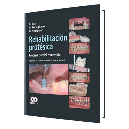 Rehabilitación Protésica. Prótesis Parcial Removible