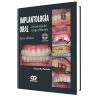 Implantología Oral