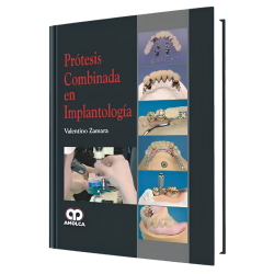 Combined prosthesis in Implantology