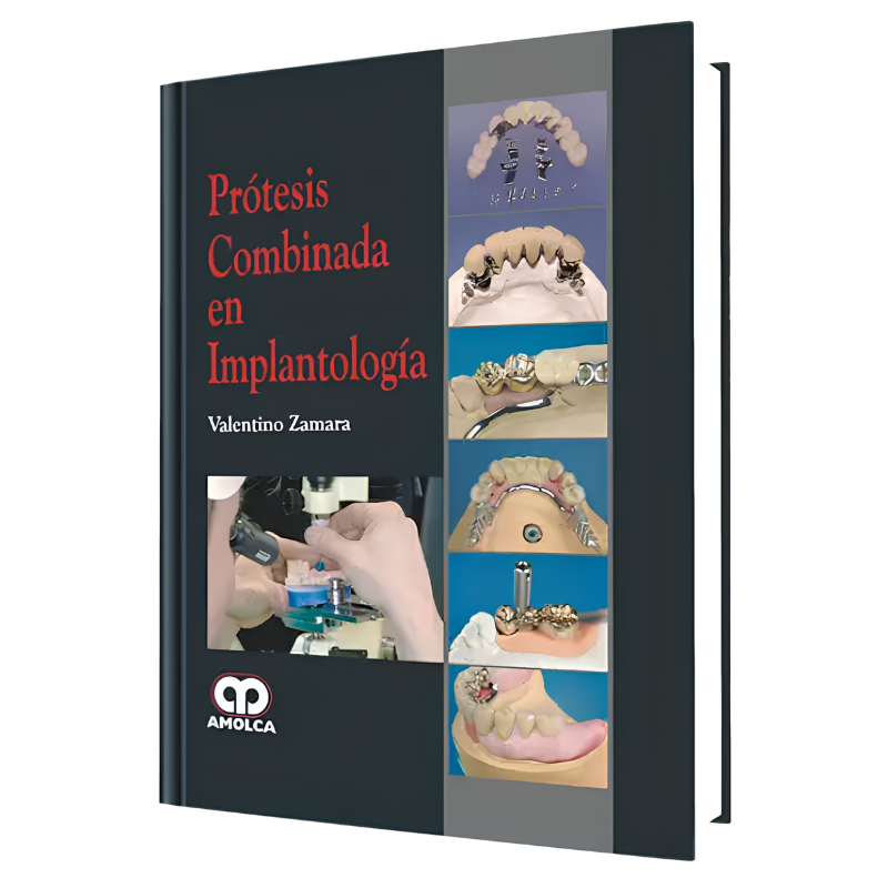 Prótesis Combinada en Implantología