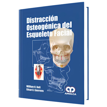 Distracción Osteogénica del Esqueleto Facial