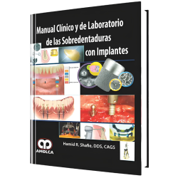 Manual Clínico y de Laboratorio de las Sobredentaduras con Implantes