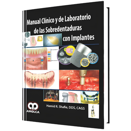 Manual Clínico y de Laboratorio de las Sobredentaduras con Implantes