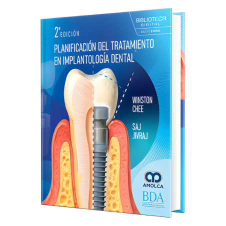 Planning of treatment in dental implantology